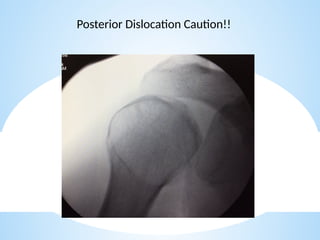 shoulder sports injuries ppt knee and shoulder | PPTX