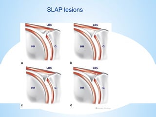 shoulder sports injuries ppt knee and shoulder | PPTX