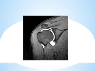 shoulder sports injuries ppt knee and shoulder | PPTX