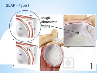 shoulder sports injuries ppt knee and shoulder | PPTX