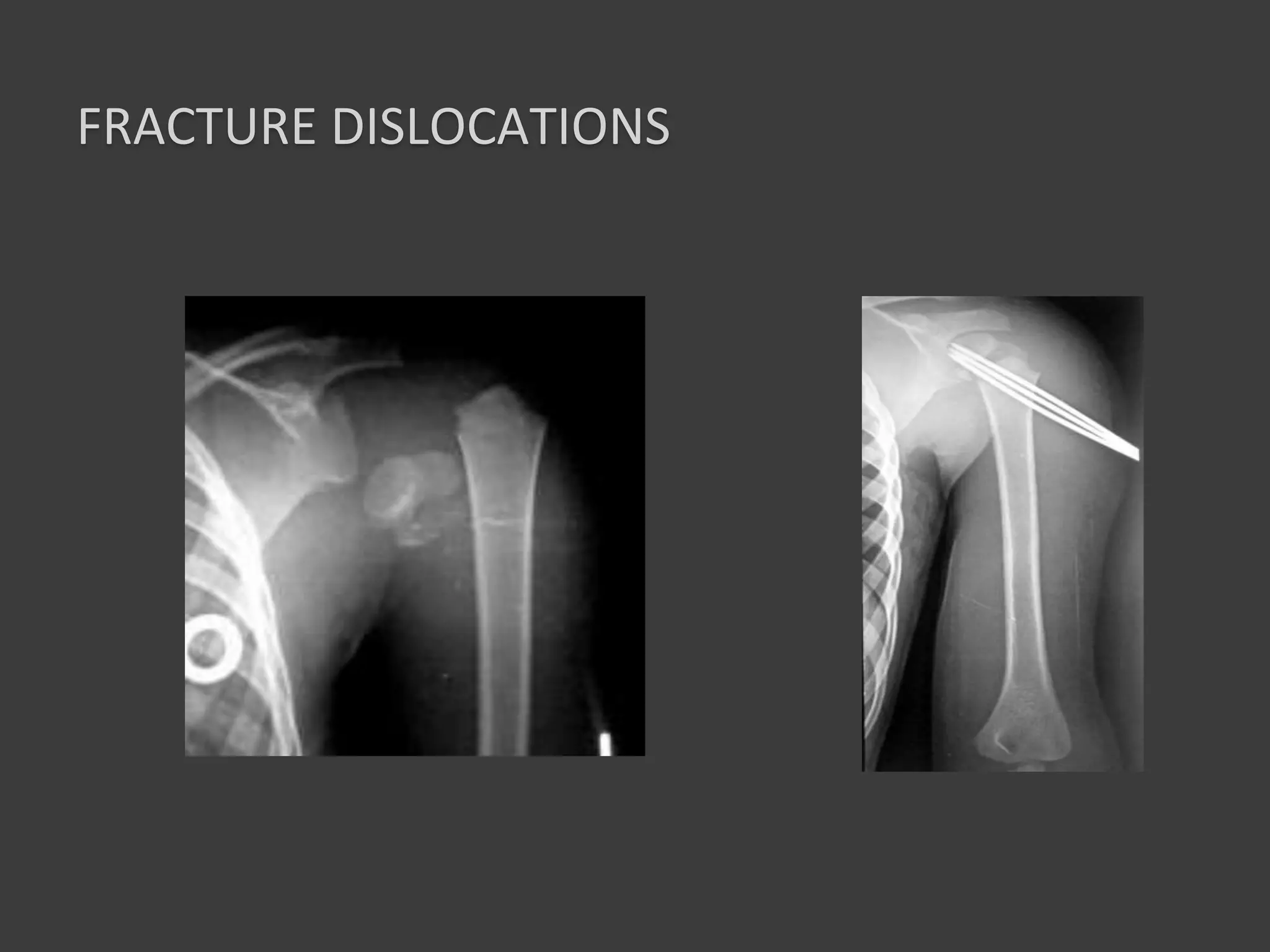 proximal humerus fracture fixation teaching | PPT