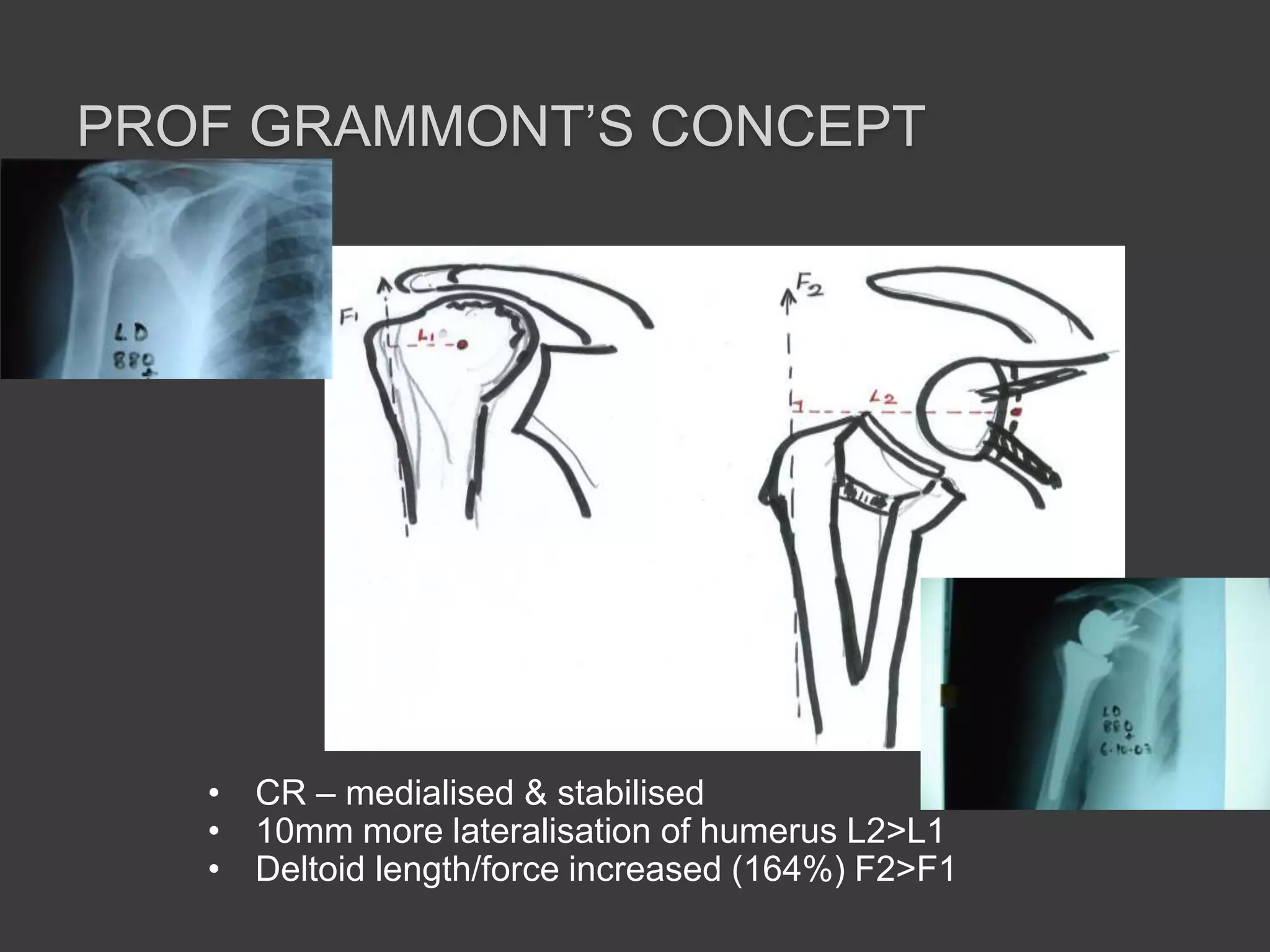 proximal humerus fracture fixation teaching | PPT