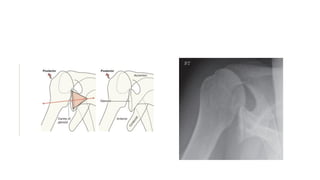 imaging of shoulder -xrays depicting the various views , the bony ...