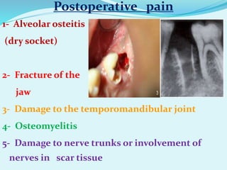 Postoperative pain
1- Alveolar osteitis
(dry socket)
2- Fracture of the
jaw
3- Damage to the temporomandibular joint
4- Osteomyelitis
5- Damage to nerve trunks or involvement of
nerves in scar tissue
 