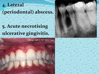 4. Lateral
(periodontal) abscess.
5. Acute necrotising
ulcerative gingivitis.
 