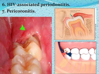 6. HIV-associated periodontitis.
7. Pericoronitis.
 