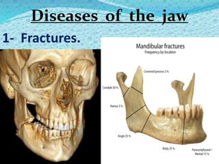 Diseases of the jaw
1- Fractures.
 