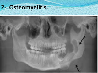 2- Osteomyelitis.
 