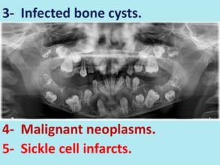 3- Infected bone cysts.
4- Malignant neoplasms.
5- Sickle cell infarcts.
 