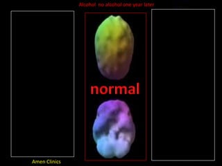 Alcohol  no alcohol one year laterusing>1 year  normalAmen Clinics