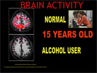 BRAIN ACTIVITYNORMALALCOHOL USER15 YEARS OLDSusan Tapert/University of California, San DiegoThe images above show the brain activity of a 15-year-old nondrinker, top, and a drinker, bottom.