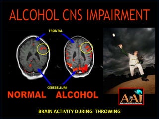 ALCOHOL CNS IMPAIRMENTFRONTALCEREBELLUMNORMALALCOHOLBRAIN ACTIVITY DURING  THROWING