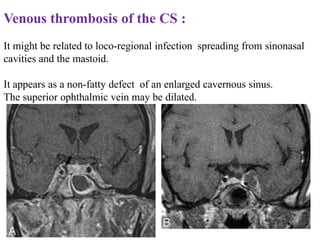 Venous thrombosis of the CS :
It might be related to loco-regional infection spreading from sinonasal
cavities and the mastoid.
It appears as a non-fatty defect of an enlarged cavernous sinus.
The superior ophthalmic vein may be dilated.
 