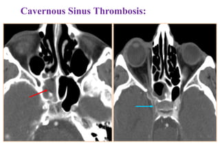 Cavernous Sinus Thrombosis:
 
