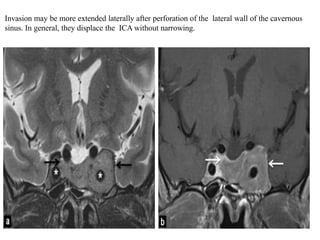 Invasion may be more extended laterally after perforation of the lateral wall of the cavernous
sinus. In general, they displace the ICA without narrowing.
 