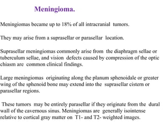 Meningioma.
Meningiomas became up to 18% of all intracranial tumors.
They may arise from a suprasellar or parasellar location.
Suprasellar meningiomas commonly arise from the diaphragm sellae or
tuberculum sellae, and vision defects caused by compression of the optic
chiasm are common clinical findings.
Large meningiomas originating along the planum sphenoidale or greater
wing of the sphenoid bone may extend into the suprasellar cistern or
parasellar regions.
These tumors may be entirely parasellar if they originate from the dural
wall of the cavernous sinus. Meningiomas are generally isointense
relative to cortical gray matter on T1- and T2- weighted images.
 
