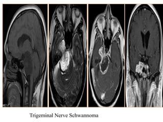 Trigeminal Nerve Schwannoma
 