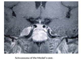 Schwannoma of the Meckel´s cave.
 