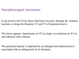 Nasopharyngeal carcinoma:
It can involve the CS by direct skull base invasion, through the foramen
lacerum, or along the branches V2 and V3 of trigeminal nerve.
The tumor appears hypointense on T2-wi, hypo- to isointense on T1-wi
and enhances after contrast.
The perineural spread is depicted by an enlarged and enhanced nerve
associated with an enlargement of its foramina
 