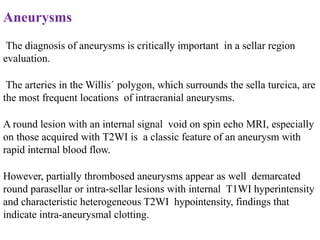 Aneurysms
The diagnosis of aneurysms is critically important in a sellar region
evaluation.
The arteries in the Willis´ polygon, which surrounds the sella turcica, are
the most frequent locations of intracranial aneurysms.
A round lesion with an internal signal void on spin echo MRI, especially
on those acquired with T2WI is a classic feature of an aneurysm with
rapid internal blood flow.
However, partially thrombosed aneurysms appear as well demarcated
round parasellar or intra-sellar lesions with internal T1WI hyperintensity
and characteristic heterogeneous T2WI hypointensity, findings that
indicate intra-aneurysmal clotting.
 
