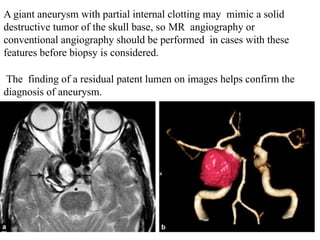 A giant aneurysm with partial internal clotting may mimic a solid
destructive tumor of the skull base, so MR angiography or
conventional angiography should be performed in cases with these
features before biopsy is considered.
The finding of a residual patent lumen on images helps confirm the
diagnosis of aneurysm.
 