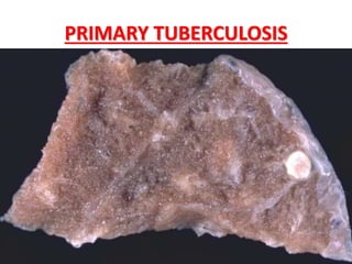 PRIMARY TUBERCULOSIS
 