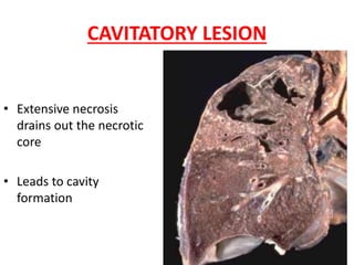 • Extensive necrosis
drains out the necrotic
core
• Leads to cavity
formation
CAVITATORY LESION
 