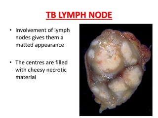 • Involvement of lymph
nodes gives them a
matted appearance
• The centres are filled
with cheesy necrotic
material
TB LYMPH NODE
 