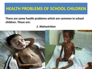 HEALTH PROBLEMS OF SCHOOL CHILDREN
There are some health problems which are common in school
children. These are:
1. Malnutrition
 