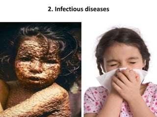 2. Infectious diseases
 