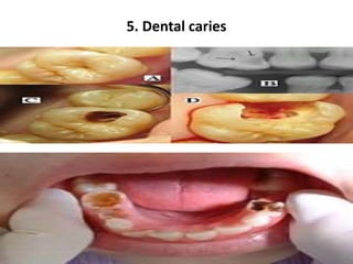 5. Dental caries
 