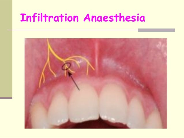 Prozac And Anesthesia