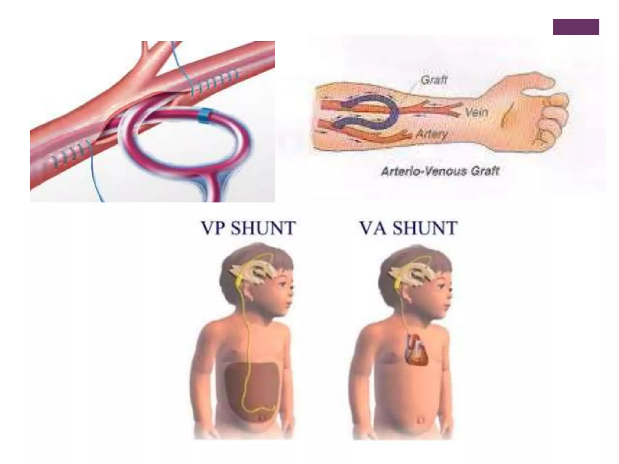 anastomosis-porto-cava-shunt-pptx-heart-and-cardiovascular