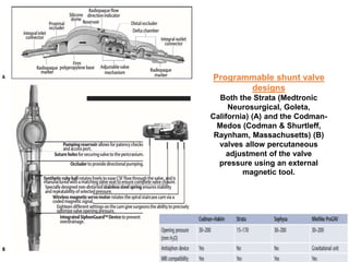 Codman Shurtleff Shunt for hydrocephalus | PPTX