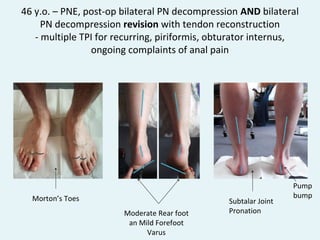 Varus Rear Foot Post Pudendal Neuralgia and Lower Extremity (Feet) Biomechanics - ICS 2011 ...