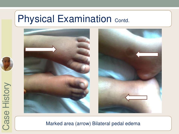 Clinical Meeting Nephrotic Syndrome (1st Relapse)