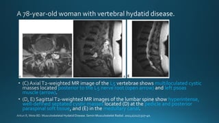 L5 multiloculated cystic
posterior to the L5 nerve root (open arrow) left psoas
muscle (arrow)
hyperintense,
well-defined septated cystic masses pedicle and posterior
paraspinal soft tissue medullary canal
 