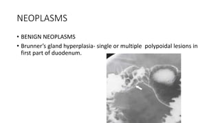 NEOPLASMS
• BENIGN NEOPLASMS
• Brunner’s gland hyperplasia- single or multiple polypoidal lesions in
first part of duodenum.
 