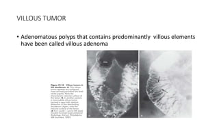 VILLOUS TUMOR
• Adenomatous polyps that contains predominantly villous elements
have been called villous adenoma
 
