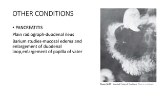 OTHER CONDITIONS
• PANCREATITIS
Plain radiograph-duodenal ileus
Barium studies-mucosal edema and
enlargement of duodenal
loop,enlargement of papilla of vater
 