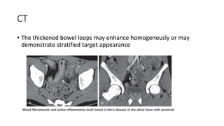 CT
• The thickened bowel loops may enhance homogenously or may
demonstrate stratified target appearance
 