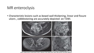 MR enteroclysis
• Characteristic lesions such as bowel wall thickening, linear and fissure
ulcers , cobblestoning are accurately depicted on T2WI.
 