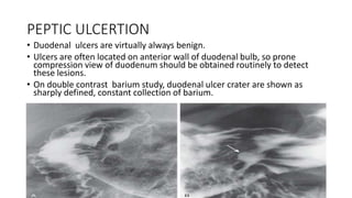 PEPTIC ULCERTION
• Duodenal ulcers are virtually always benign.
• Ulcers are often located on anterior wall of duodenal bulb, so prone
compression view of duodenum should be obtained routinely to detect
these lesions.
• On double contrast barium study, duodenal ulcer crater are shown as
sharply defined, constant collection of barium.
 