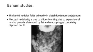 Barium studies.
• Thickened nodular folds primarily in distal duodenum an jejunum.
• Mucosal nodularity is due to villous blunting due to expansion of
lamina propria distended by fat and macrophages containing
digested bacilli.
 