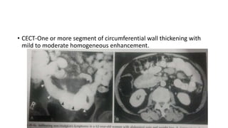 • CECT-One or more segment of circumferential wall thickening with
mild to moderate homogeneous enhancement.
 