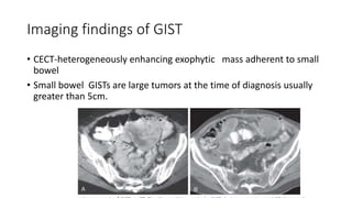 Imaging findings of GIST
• CECT-heterogeneously enhancing exophytic mass adherent to small
bowel
• Small bowel GISTs are large tumors at the time of diagnosis usually
greater than 5cm.
 