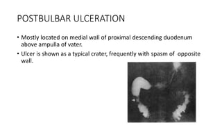 POSTBULBAR ULCERATION
• Mostly located on medial wall of proximal descending duodenum
above ampulla of vater.
• Ulcer is shown as a typical crater, frequently with spasm of opposite
wall.
 