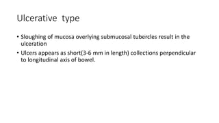 Ulcerative type
• Sloughing of mucosa overlying submucosal tubercles result in the
ulceration
• Ulcers appears as short(3-6 mm in length) collections perpendicular
to longitudinal axis of bowel.
 