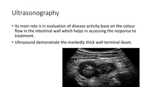 Ultrasonography
• Its main role is in evaluation of disease activity base on the colour
flow in the intestinal wall which helps in accessing the response to
treatment.
• Ultrasound demonstrate the markedly thick wall terminal ileum.
 