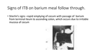 Signs of ITB on barium meal follow through.
• Stierlin’s signs –rapid emptying of cecum with passage of barium
from terminal ileum to ascending colon, which occurs due to irritable
mucosa of cecum
 